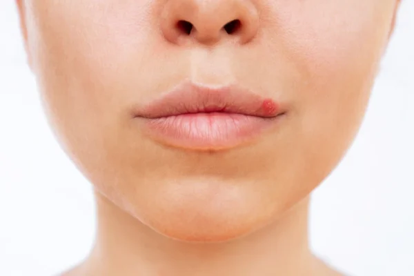 Trucco permanente labbra ed herpes