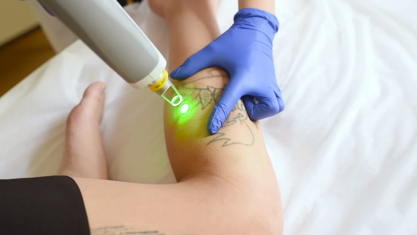 Rimozione laser tatuaggi