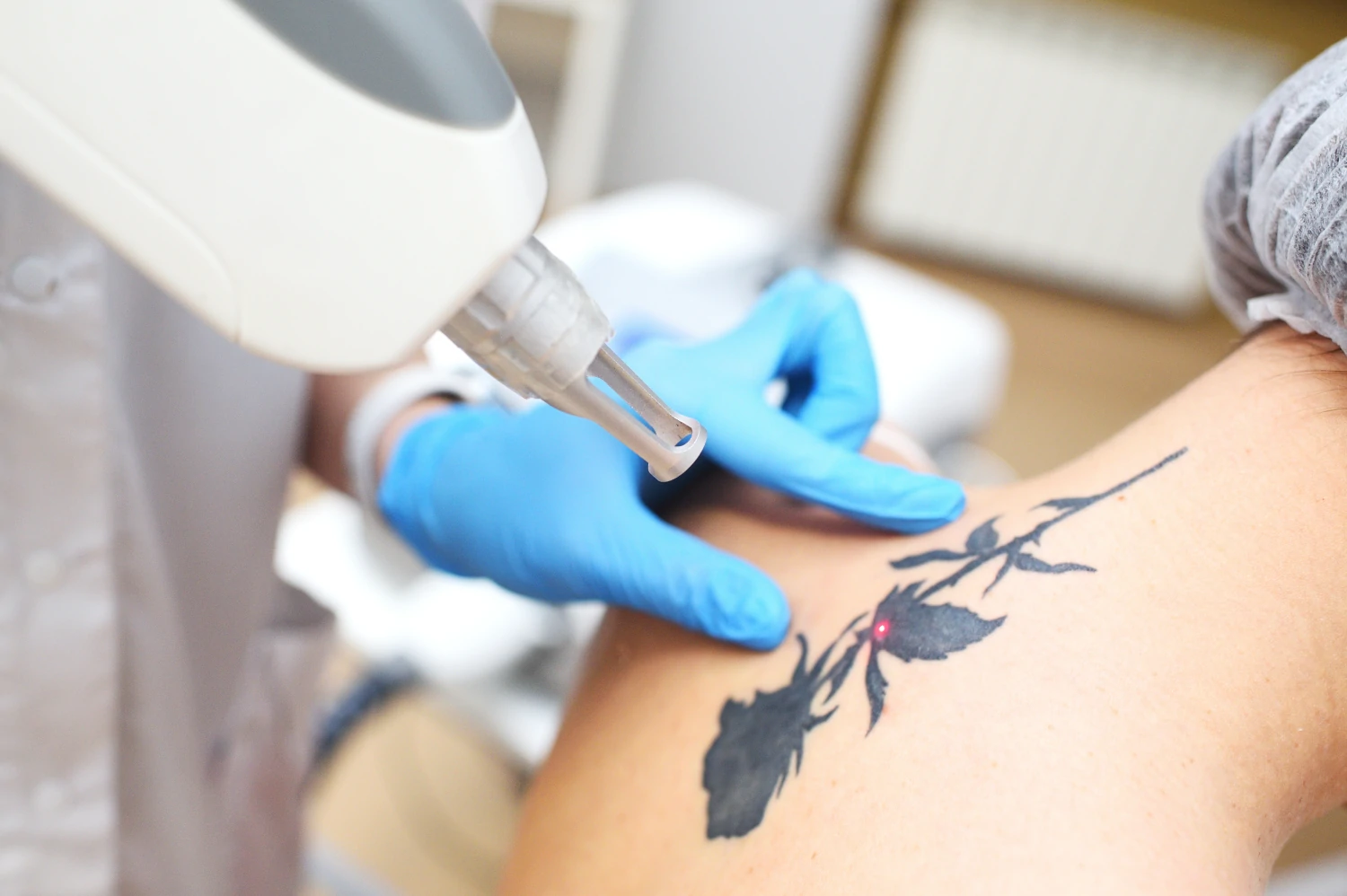 Rimuovere tatuaggio tramite laser a Torino