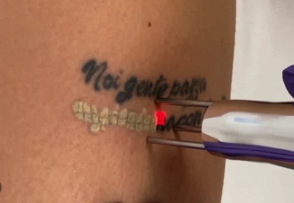 Le sedute necessarie per la rimozione del tatuaggio tramite laser